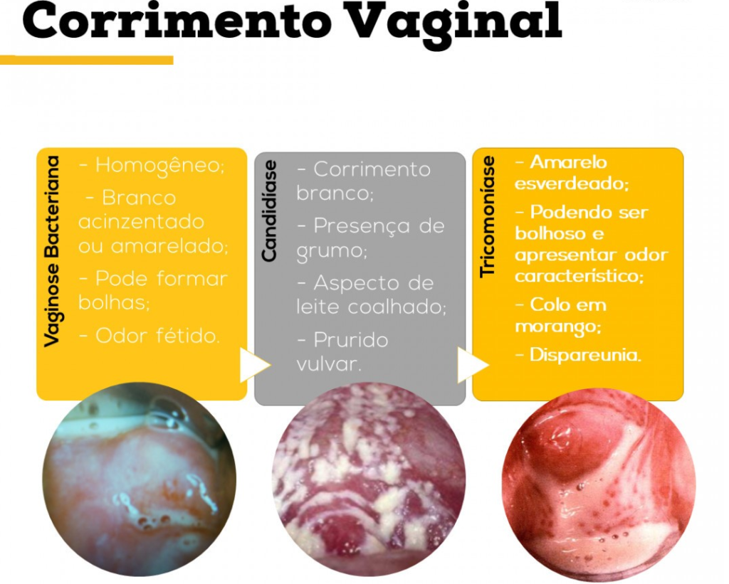 Corrimentos Vaginais Anna Na Saúde 0576